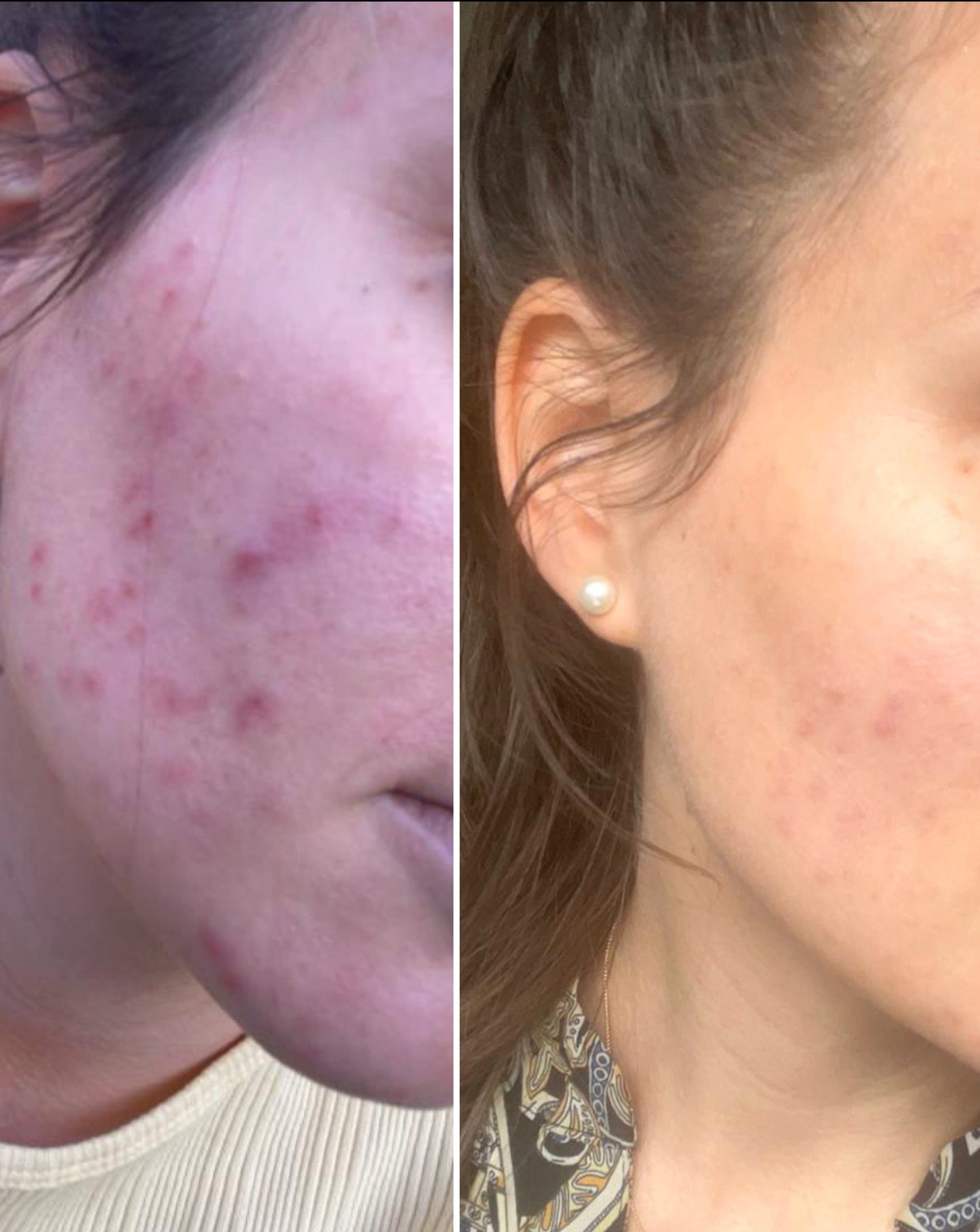 S3 Akne Spezial Serum